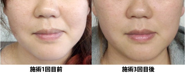 小顔矯正 施術1回目と3回目の前後の比較写真